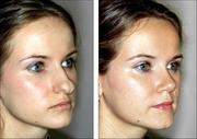 rhinoplasty in qatar