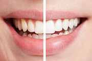 Comprehensive Teeth Whitening Training