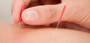 Acupuncture Treatment in waterloo