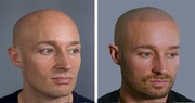 Balding,  Thinning Hair or Losing Hair - Best Solution for You. 